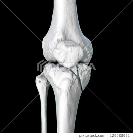 Tibia fracture Schatzker type IV, 3D illustration Tibia fracture Schatzker type IV, 3D illustration 129388951