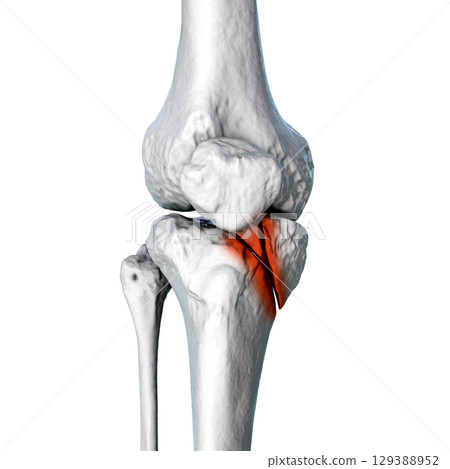 Tibia fracture Schatzker type IV, 3D illustration Tibia fracture Schatzker type IV, 3D illustration 129388952