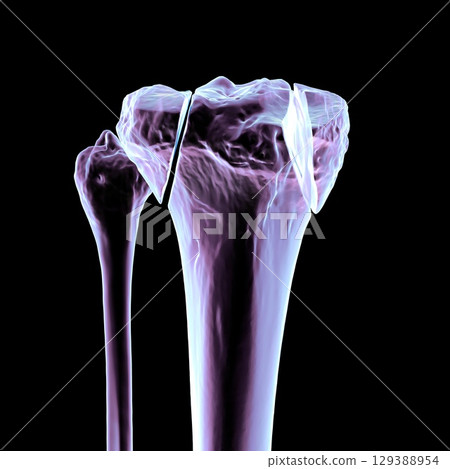 Tibia fracture Schatzker type V, 3D illustration Tibia fracture Schatzker type V, 3D illustration 129388954