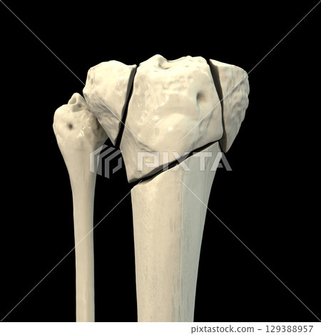 Tibia fracture Schatzker type VI, 3D illustration Tibia fracture Schatzker type VI, 3D illustration 129388957