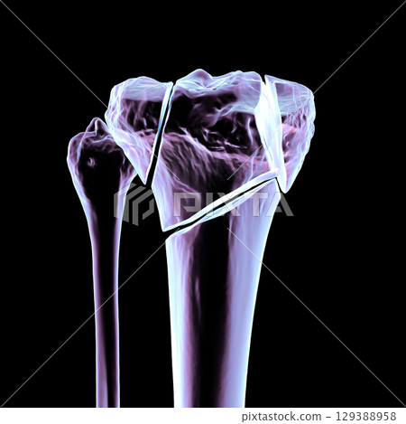 Tibia fracture Schatzker type VI, 3D illustration Tibia fracture Schatzker type VI, 3D illustration 129388958