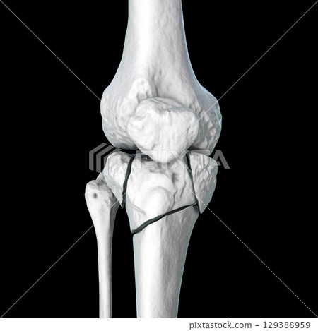 Tibia fracture Schatzker type VI, 3D illustration Tibia fracture Schatzker type VI, 3D illustration 129388959