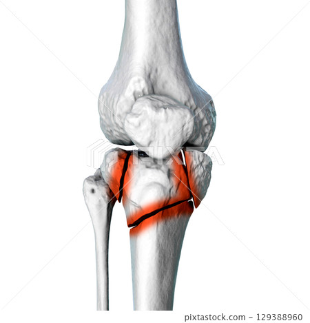 Tibia fracture Schatzker type VI, 3D illustration Tibia fracture Schatzker type VI, 3D illustration 129388960
