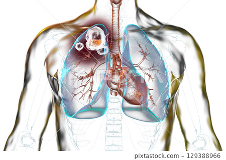 Cavitary tuberculosis, illustration 129388966