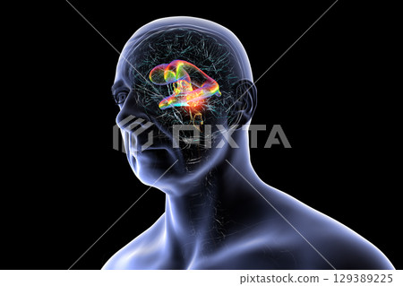 A brain tumor causing hydrocephalus, 3D illustration 129389225