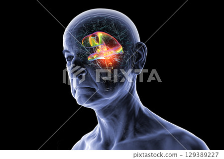 A brain tumor causing hydrocephalus, 3D illustration 129389227
