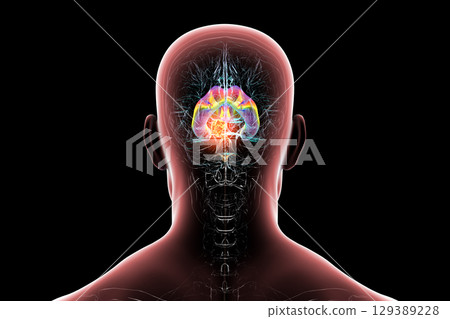 A brain tumor causing hydrocephalus, 3D illustration 129389228
