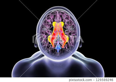Enlarged lateral ventricles of the brain, 3D illustration Enlarged lateral ventricles of the brain, 3D illustration 129389246