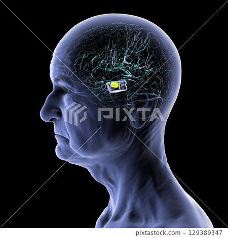 Human brain with degenerated substantia nigra in Parkinson's disease, 3D illustration. 129389347