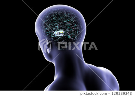 Human brain with degenerated substantia nigra in Parkinson's disease, 3D illustration. 129389348