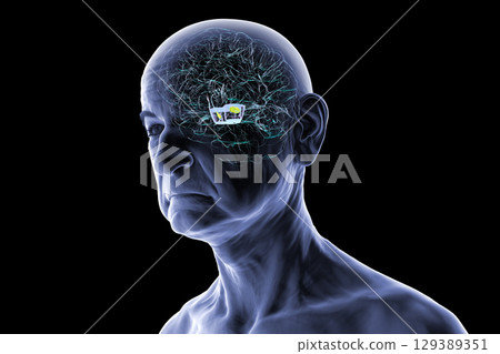 Human brain with degenerated substantia nigra in Parkinson's disease, 3D illustration. 129389351