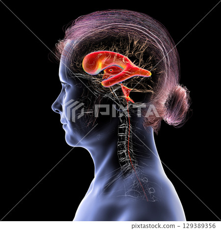 Normal pressure hydrocephalus, 3D illustration 129389356