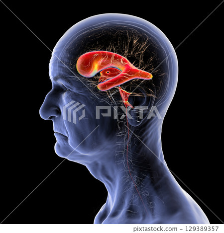 Normal pressure hydrocephalus, 3D illustration 129389357