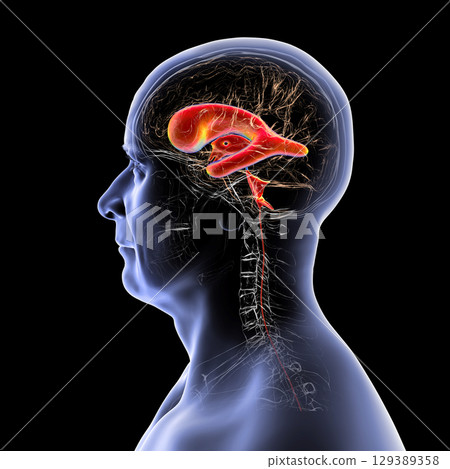 Normal pressure hydrocephalus, 3D illustration Normal pressure hydrocephalus, 3D illustration 129389358