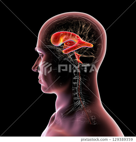 Normal pressure hydrocephalus, 3D illustration Normal pressure hydrocephalus, 3D illustration 129389359