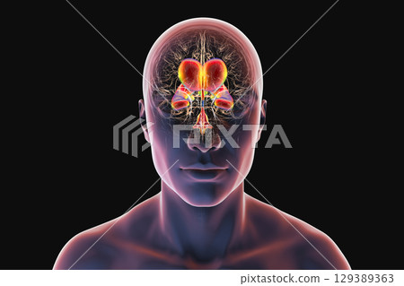Normal pressure hydrocephalus, 3D illustration 129389363
