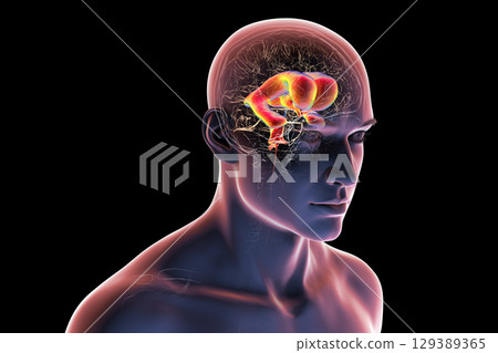 Normal pressure hydrocephalus, 3D illustration 129389365