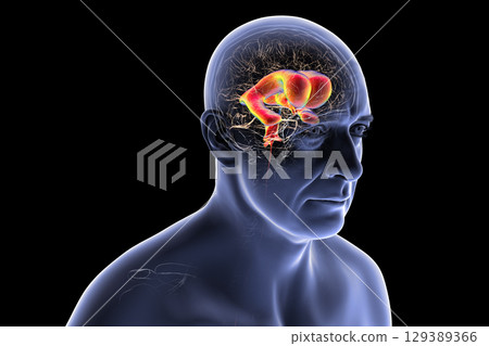Normal pressure hydrocephalus, 3D illustration 129389366