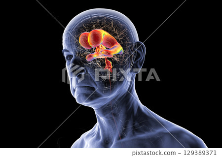 Normal pressure hydrocephalus, 3D illustration 129389371