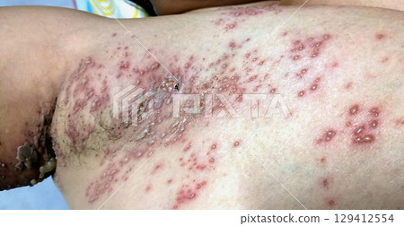 Close-Up of Herpes Skin Outbreak in woman's Armpit Area Close-Up of Herpes Skin Outbreak in woman's Armpit Area 129412554