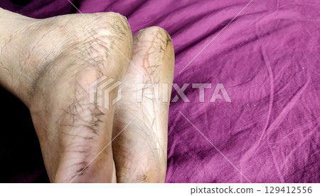Close-Up of Cracked Heels and Bare Feet 129412556