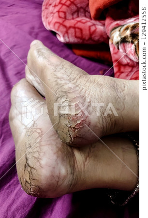 Close-Up of Cracked Heels and Bare Feet Close-Up of Cracked Heels and Bare Feet 129412558