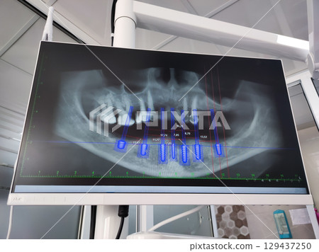 Detailed dental CT scan showing axial, coronal, sagittal, and 3D views of jaw and teeth for diagnostic and treatment plan Detailed dental CT scan showing axial, coronal, sagittal, and 3D views of jaw and teeth for diagnostic and treatment plan 129437250
