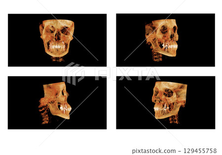 Computed tomography of adult female patient with dental root and implant treatments. Dental x-ray of an adult patient showing teeth, jaws and a dental implant. Modern digital tomography for dentistry 129455758