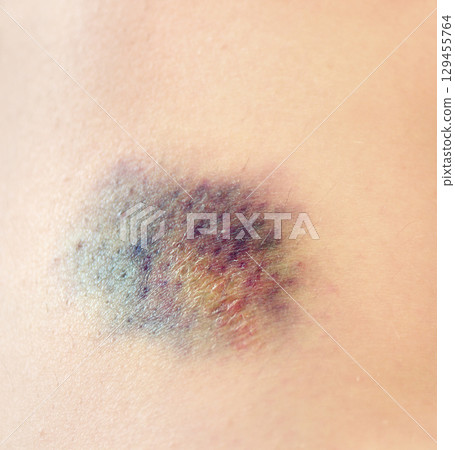 Close up purple bruise on skin. Bruise from impact. Bruising and hematoma on human body 129455764