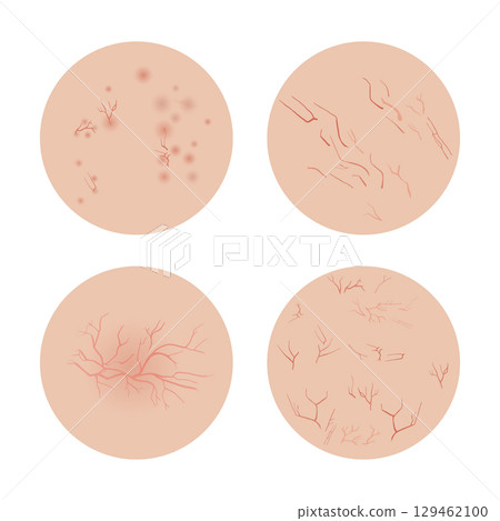 Four Types of Rosacea Showing Different Symptoms on Skin 129462100