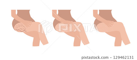 Woman checking stretch marks on her legs, showing different stages of healing 129462131