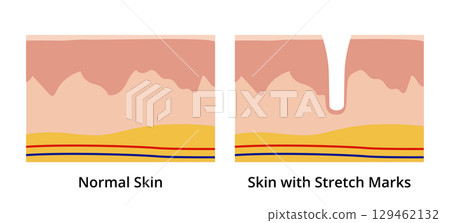 Normal skin versus skin with stretch marks Normal skin versus skin with stretch marks 129462132