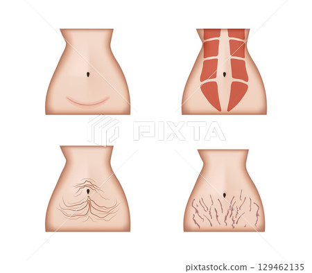 Female abdomen showing scar, muscles, flabbiness and stretch marks Female abdomen showing scar, muscles, flabbiness and stretch marks 129462135