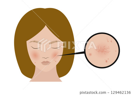 Woman showing rosacea symptoms on face skin 129462136