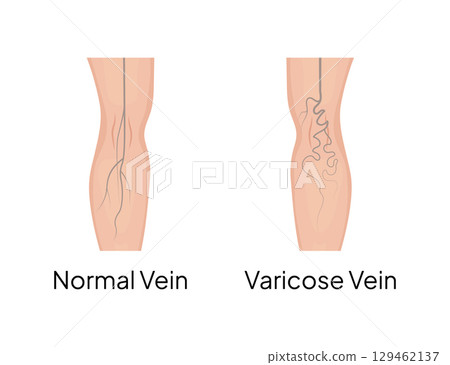 Comparing normal and varicose veins in human leg Comparing normal and varicose veins in human leg 129462137