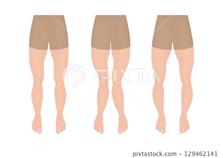 Different leg curvatures and deformities, genu varum, valgum and recurvatum Different leg curvatures and deformities, genu varum, valgum and recurvatum 129462141