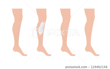 Hair removal cream being applied on hairy legs 129462148