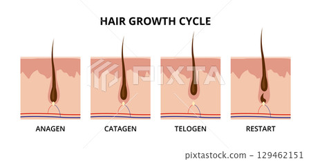 Hair growth cycle showing anagen, catagen, telogen and restart phases 129462151