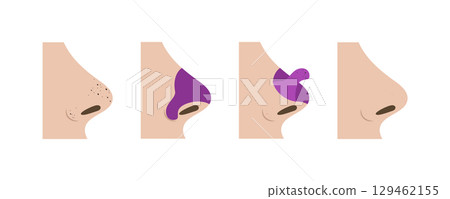 Removing blackheads with a cosmetic pore strip, four steps infographic 129462155