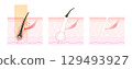 How hair falls out after medical hair removal or laser hair removal 129493927