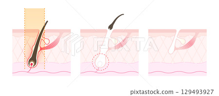 How hair falls out after medical hair removal or laser hair removal How hair falls out after medical hair removal or laser hair removal 129493927