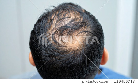 男性頭髮稀疏和頭皮的特寫 3DCG 插圖 129496718