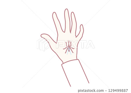 Mosquito bite person hand 129499887