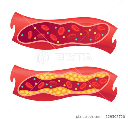 Types of cholesterol in human blood vessels. Normal and narrowed artery for explanation diseases. High-Density Lipoprotein HDL and Low-Density Lipoprotein LDL. Vector illustration 129502720