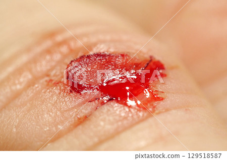Injury of middle finger of right hand with bleeding. Flayed skin,blood and lymph 129518587