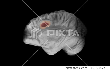 Sagittal Human Brain with Glioblastoma in Left Frontal Lobe 129544246