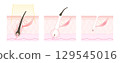 Image of hair removal, illustration of beauty hair removal and laser hair removal 129545016