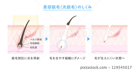 除毛圖像、美容除毛和雷射除毛插圖 129545017
