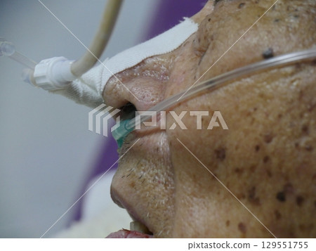 Nasogastric tube Nasogastric tube 129551755