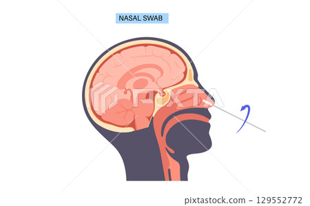Nasal swab procedure 129552772